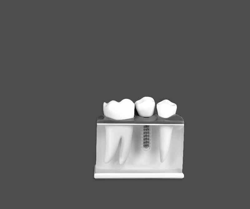 cuanto-tiempo-dura-proceso-de-implantes-dentales-1