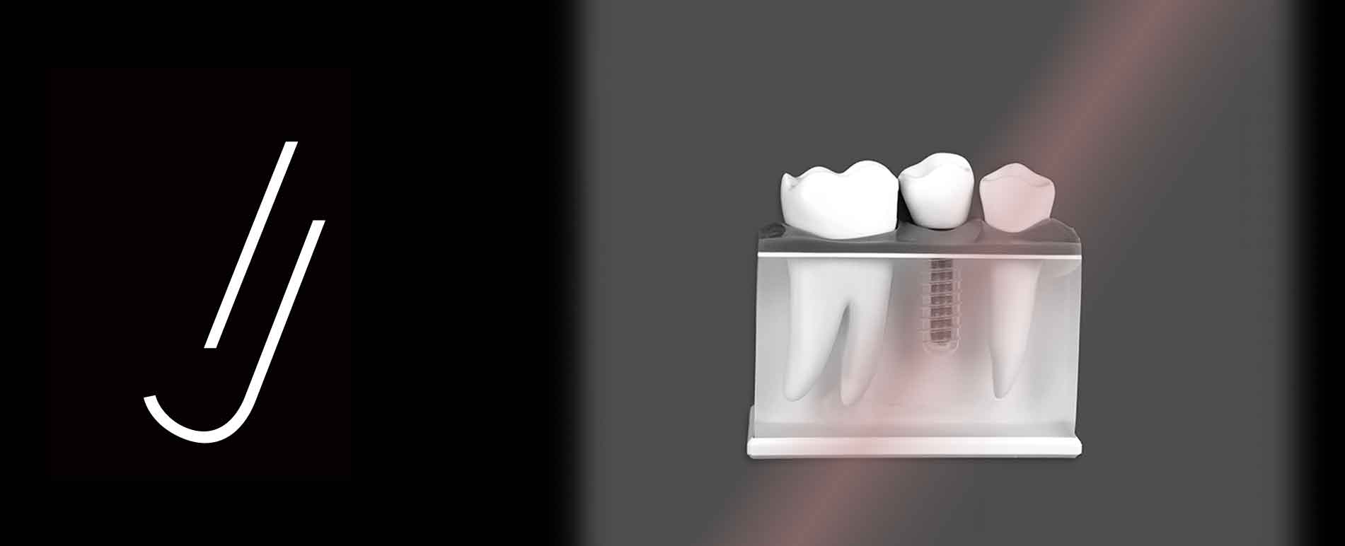 cuanto-tiempo-dura-proceso-de-implantes-dentales-portada